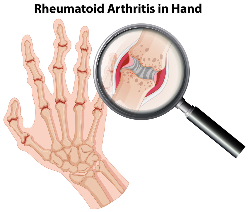 Chiropractors for Relief From Arthritis Pain In Chicago