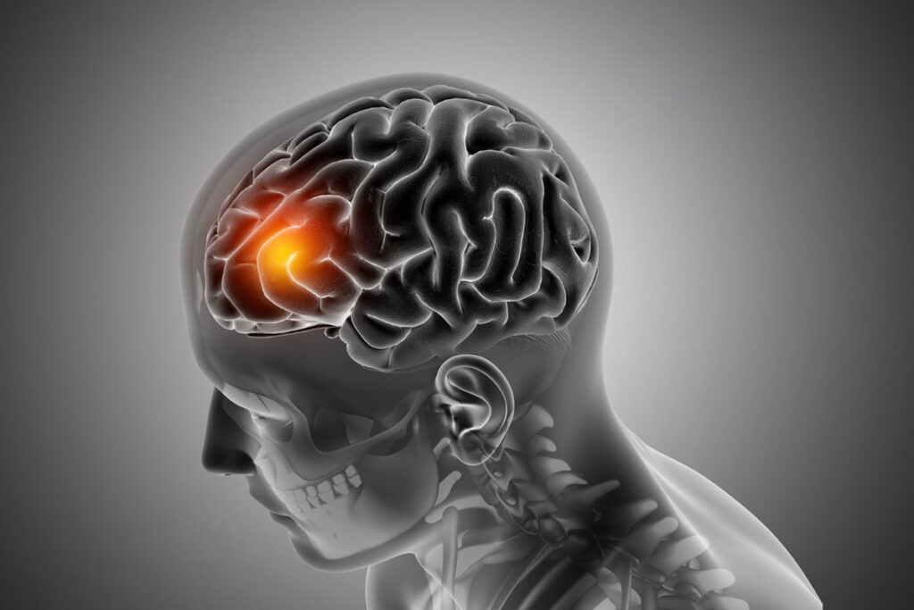 Atención quiropráctica para lesiones cerebrales traumáticas en Chicago